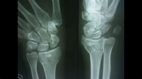 Distal radius fracture - wikidoc